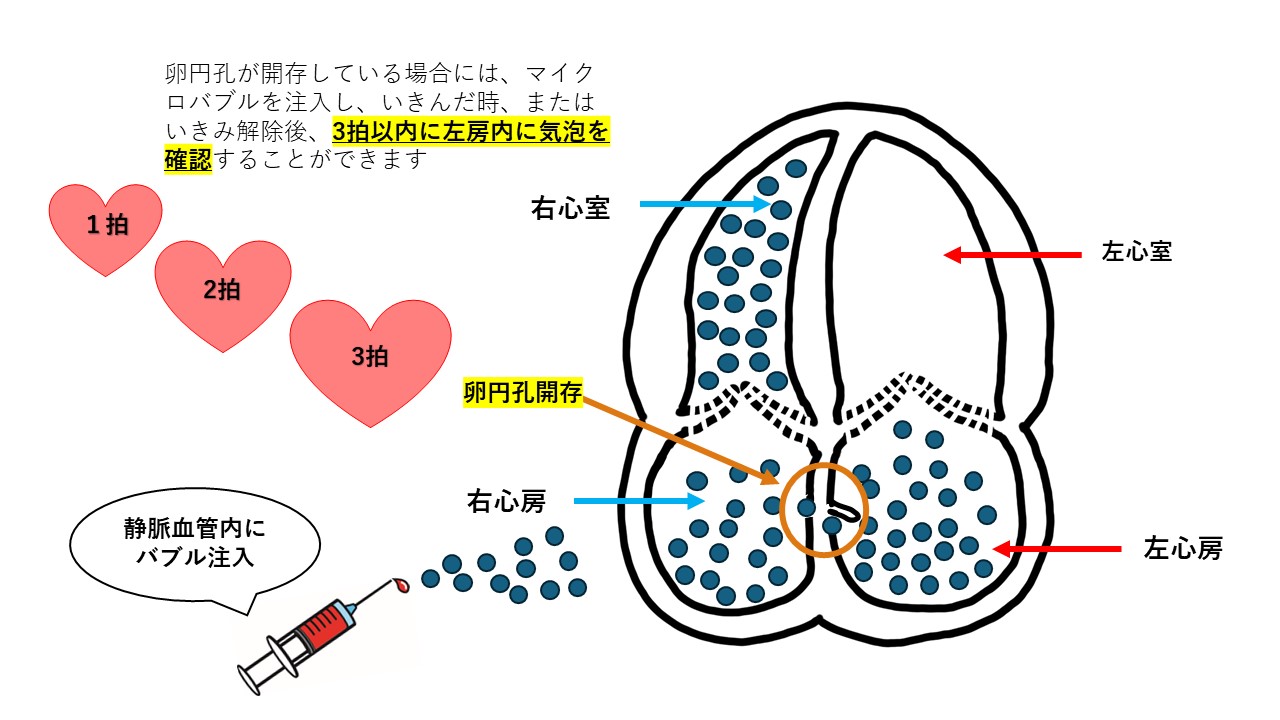 若年性脳梗塞は心臓に原因があることも～卵円孔開存の検査について～ - 東京心臓血管内科クリニック ブログ