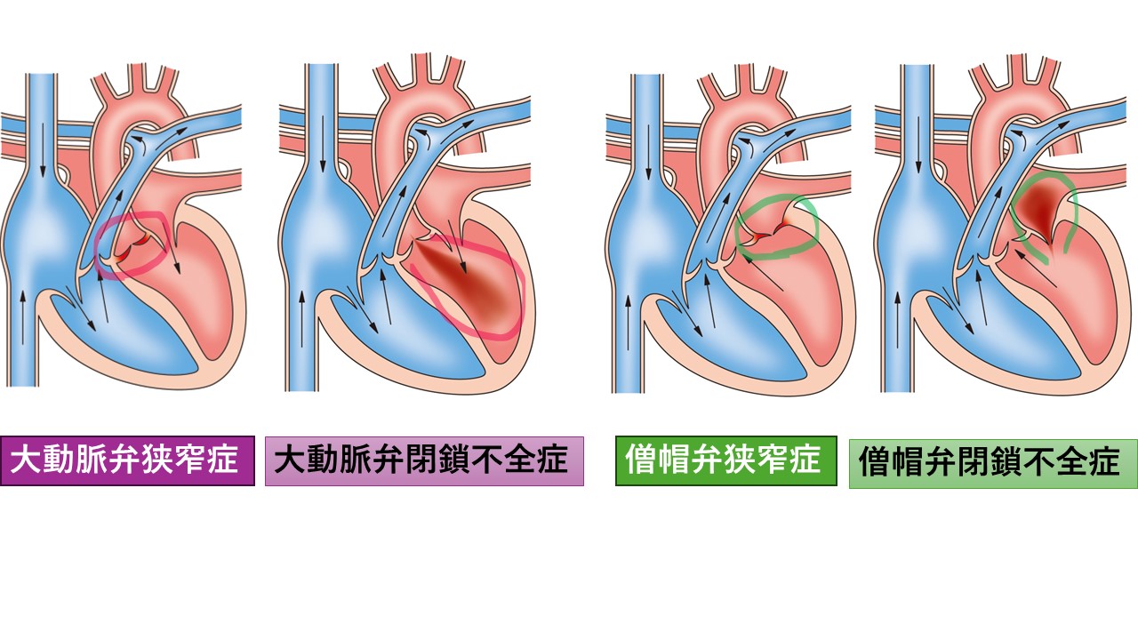 大動脈 弁 閉鎖 不全 症