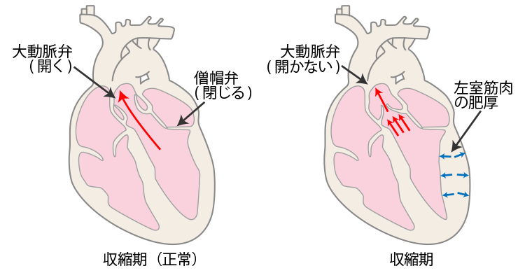 図2．大動脈弁狭窄症