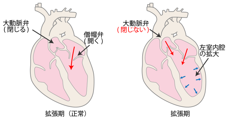 図4．大動脈弁閉鎖不全症